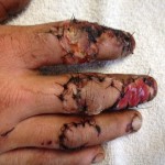 McKay's right hand after the accident.